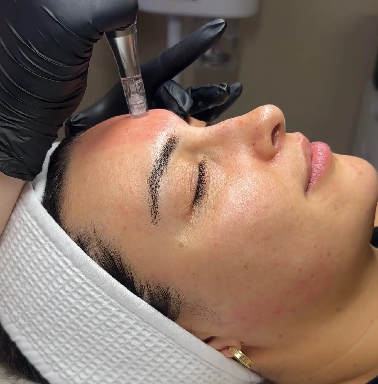 Microneedling clinical skin session